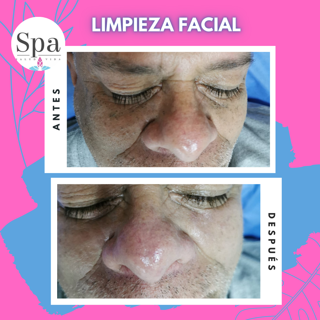 Limpieza Facial Profunda suba
